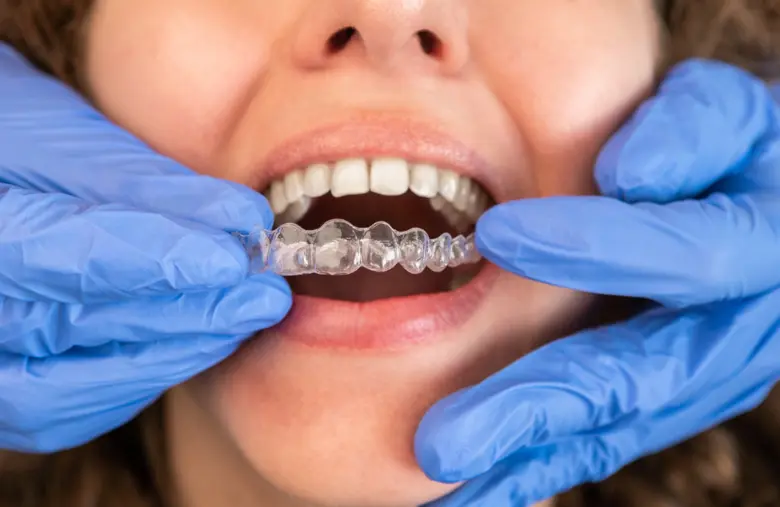 การจัดฟันแบบใส กำลังได้รับความนิยมอย่างมา...